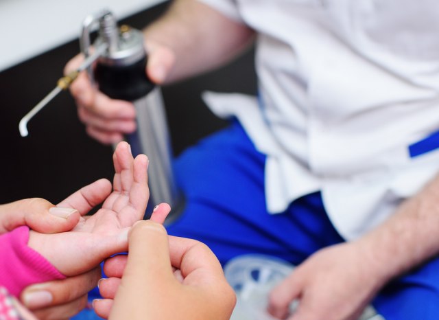 Uklanjanje bradavica teènim azotom - nije potrebna anestezija i nema ožiljaka
